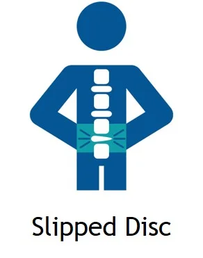 Slipped Disc Treatment